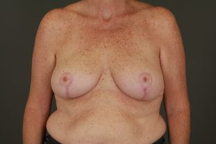 Breast Reduction 15