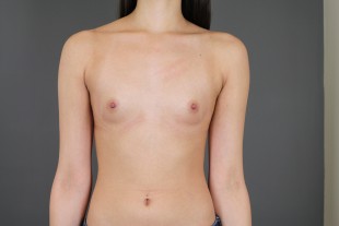 Breast Augmentation 50