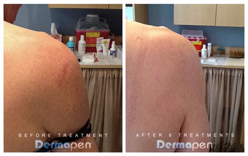 Dermapen Before & After