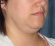 necklift-01-before-b-flint