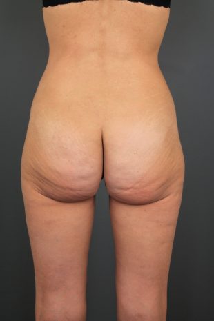 Posterior Belt Lipectomy