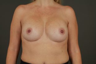 Complex Revisionary Breast Case 8