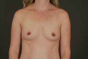 Breast Augmentation 43