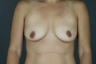 breast augmentation patient 43