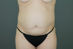 Tummy Tuck 36