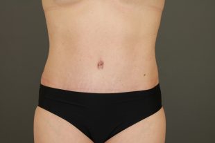 Tummy Tuck 36