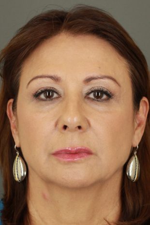 Blepharoplasty 13