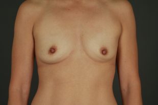 Breast Augmentation 44