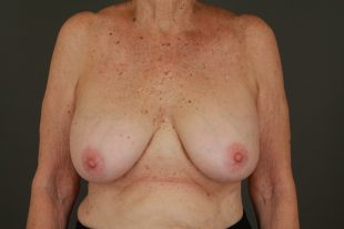 Breast Implant Exchange and Lift