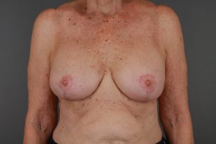 Breast Implant Exchange and Lift