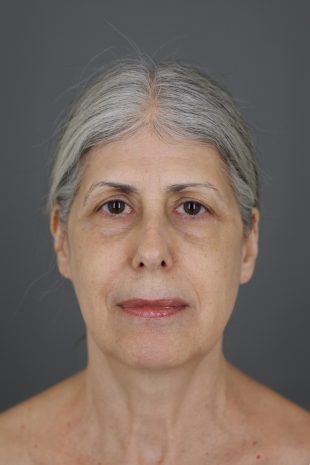 Facelift, Eye lid lift, Brow Lift Patient