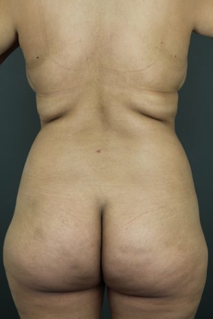 Liposuction 12