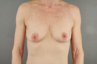 Breast augmentation with mastopexy