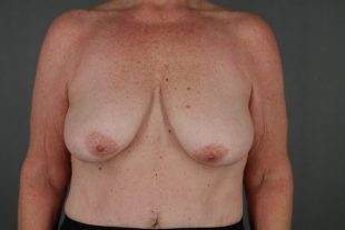 Breast Augmentation with a Breast Lift 39