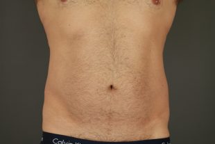 Male Liposuction 4