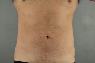 Male Liposuction 4