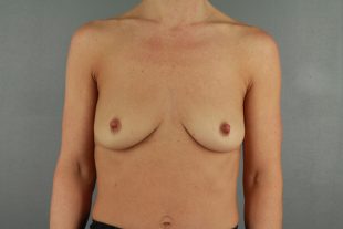 Breast Augmentation 55