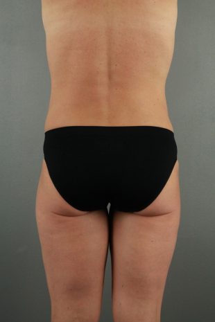 Female liposuction