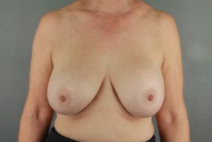 Breast Implant Exchange 16