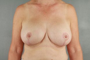 Breast Implant Exchange 16
