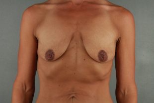 Mastopexy Augmentation client 5