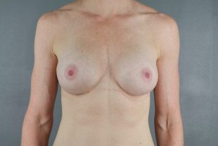 client 2 breast augmentation