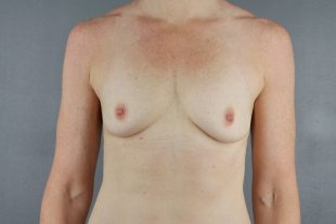 client 2 breast augmentation