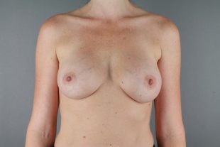breast augmentation client 3
