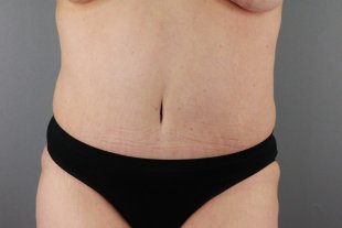 client 11- extended abdominoplaty with sal flanks