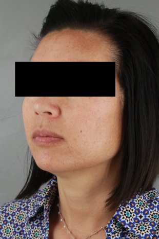 client 12 -KYBELLA