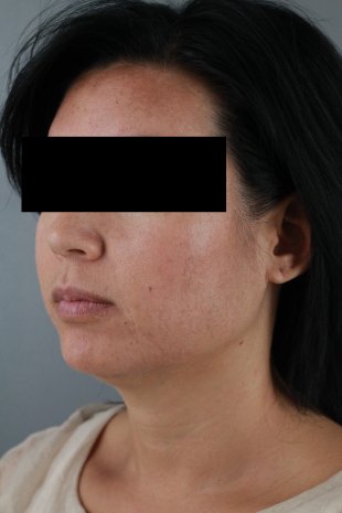 client 12 -KYBELLA