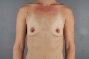 Breast Augmentation client 13