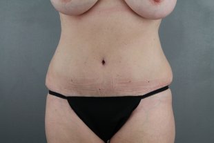 client 14 Abdominoplasty with Liposuction to Flanks