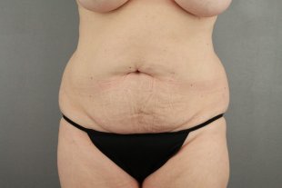 client 14 Abdominoplasty with Liposuction to Flanks