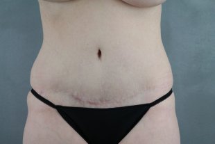client 15 – Abdominoplasty with Liposuction to the flanks