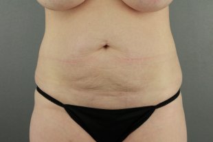 client 15 – Abdominoplasty with Liposuction to the flanks