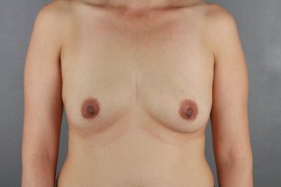 client 17 Breast Augmentation