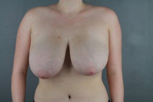 client 18 Breast reduction