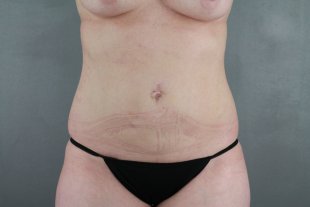 Liposuction client 19