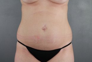 Liposuction client 19