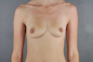 client 20 breast augmentation