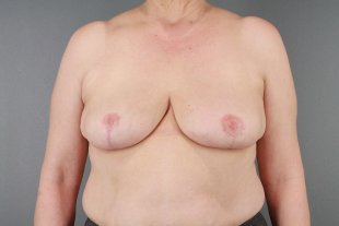 client 24 Breast Reduction