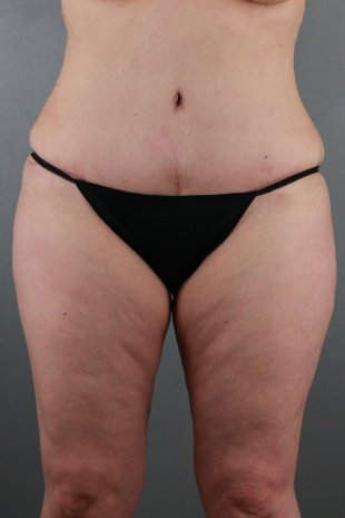 client 28 abdominoplasty with SAL flanks, back and inner thighs