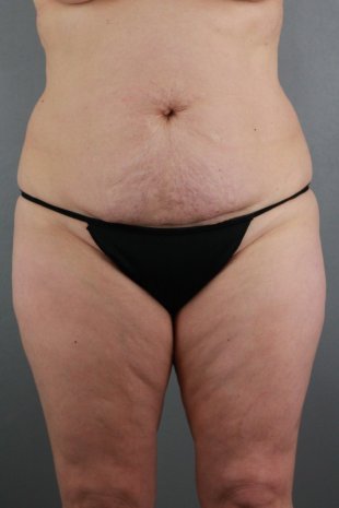 client 28 abdominoplasty with SAL flanks, back and inner thighs