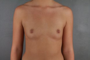 client 42 Breast Augmentation
