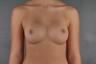 client 42 Breast Augmentation