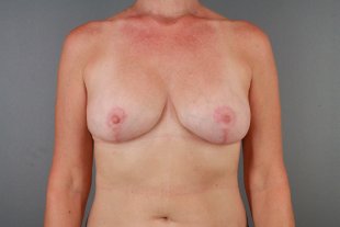 Client 43 Mastopexy Augmentation