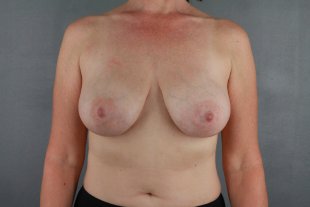 Client 43 Mastopexy Augmentation