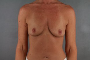 Client 44 Breast Augmentation