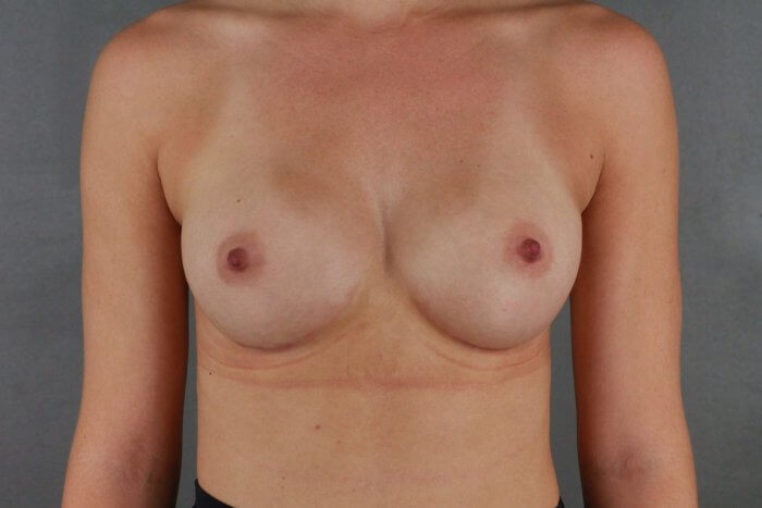 Client 48 Breast Augmentation